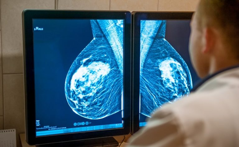 Senado aprova projetos que antecipam idade mínima para mamografia no SUS