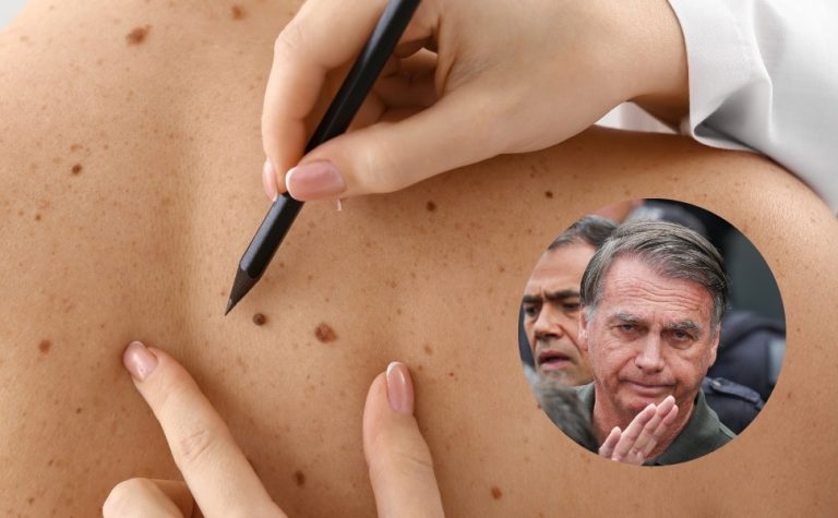 Câncer de pele de Bolsonaro é agressivo? Conheça características da doença