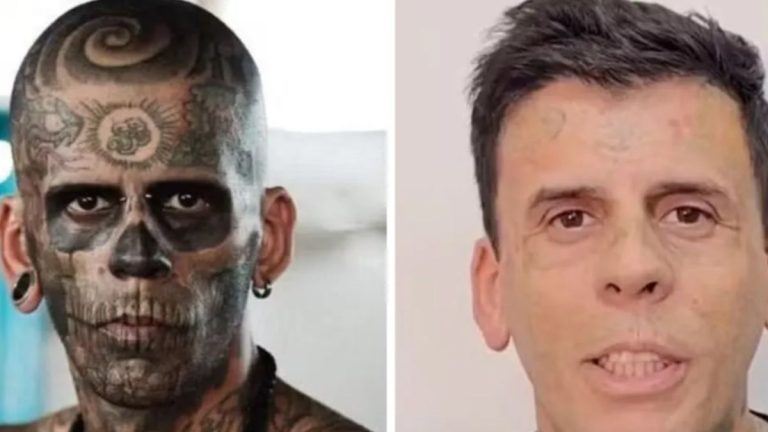 Homem mais tatuado do Brasil está irreconhecível após remoção de tatuagens