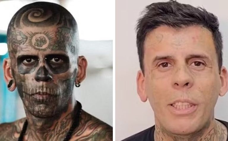 Mais tatuado do Brasil aparece irreconhecível após remoção de tatuagens