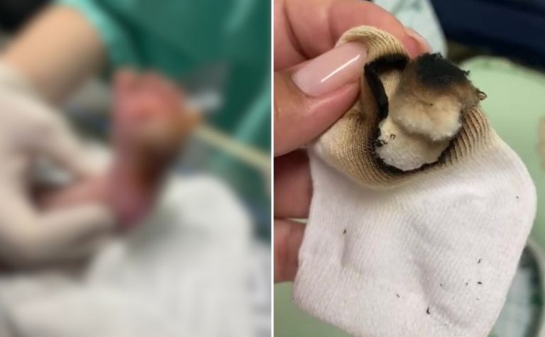 Queimadura em bebê foi erro individual, diz auditoria