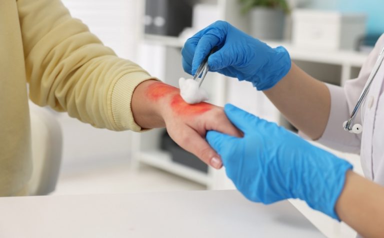 SUS terá transplante de membrana amniótica para tratamento de queimaduras