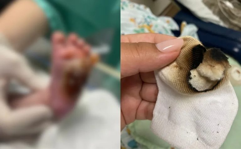 Técnica de enfermagem é demitida após bebê ter pé queimado em hospital da Serra