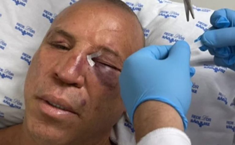 Wanderlei Silva teve nariz quebrado e recebeu pontos em briga após luta contra Popó