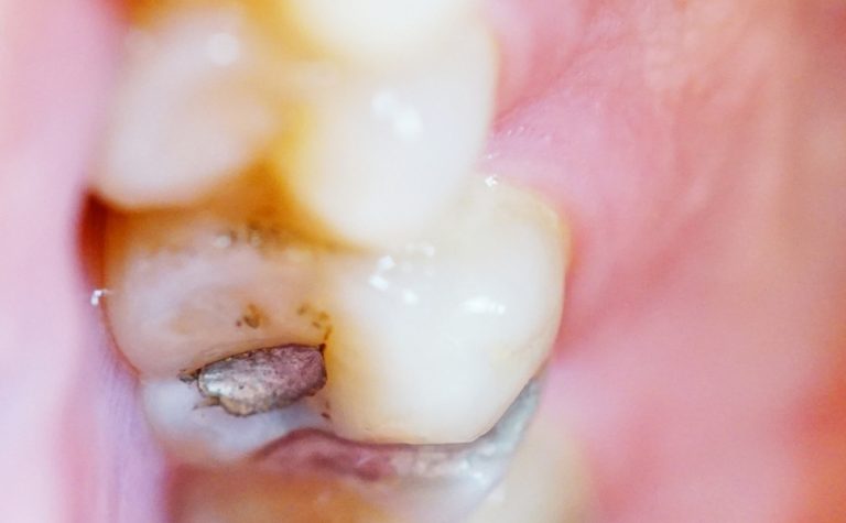 Brasil vai parar de usar restaurações prateadas de amálgama nos dentes
