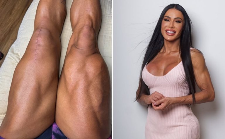 Gracyanne Barbosa mostra cicatrizes após cirurgia e desabafa sobre recuperação