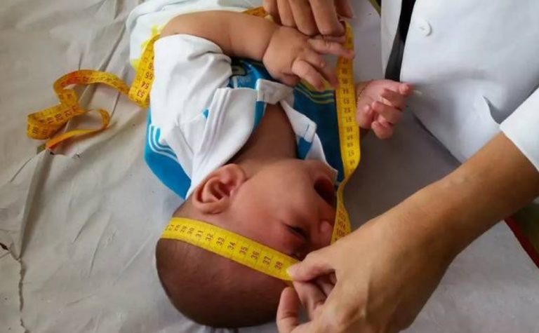 INSS paga pensão vitalícia para crianças com zika vírus