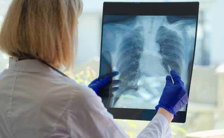 Tuberculose mata mais de 1,2 milhão de pessoas por ano, aponta OMS