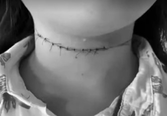Criança de 10 anos é ferida no pescoço por linha com cerol em Camaragibe