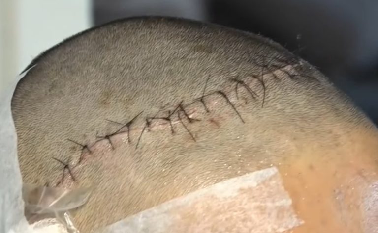 Adolescente sofre golpe em aula experimental de kickboxing e acaba internado na UTI