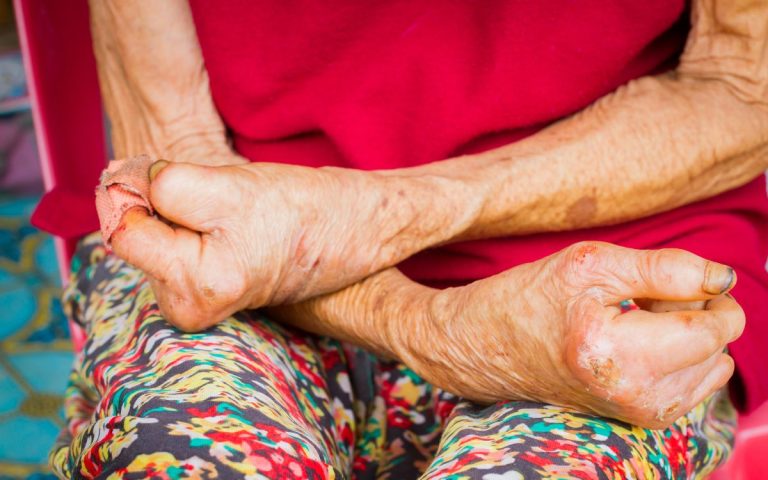 Pernambuco registra queda de 14,2% em casos novos de hanseníase, mas mantém alerta