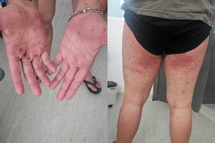 Pico Paraná: irmã mostra imagens das lesões do jovem que ficou desaparecido por 4 dias em trilha