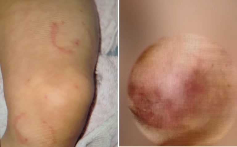 Mãe e padrasto são presos suspeitos de agredir bebê com mordidas em Vila Velha
