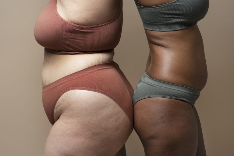Não é gordura localizada nem celulite: entenda o que é o lipedema e como tratar