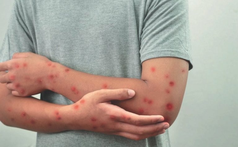 Saiba como se proteger da mpox; Brasil já registrou 57 casos neste ano
