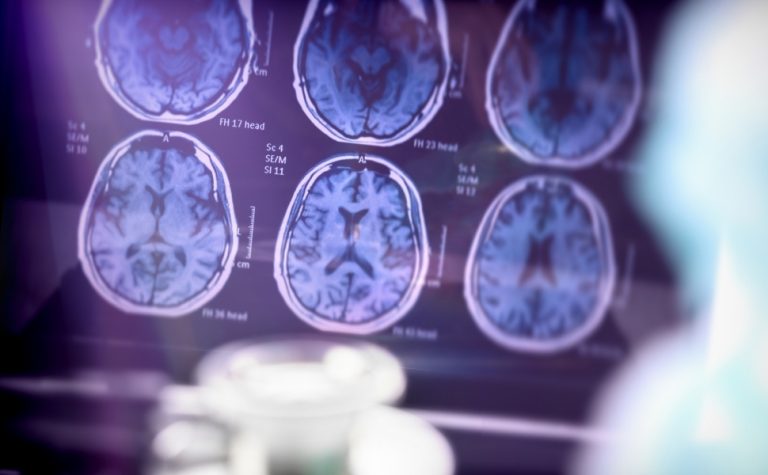 Alzheimer é a segunda doença mais temida pelos brasileiros, atrás apenas do câncer