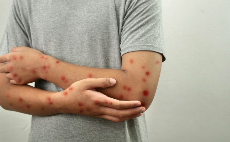Casos de mpox mais que dobram em 20 dias, com 129 confirmações no Brasil