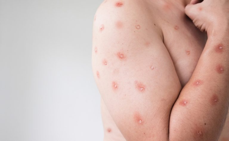 Espírito Santo confirma segundo caso de Mpox em 2026