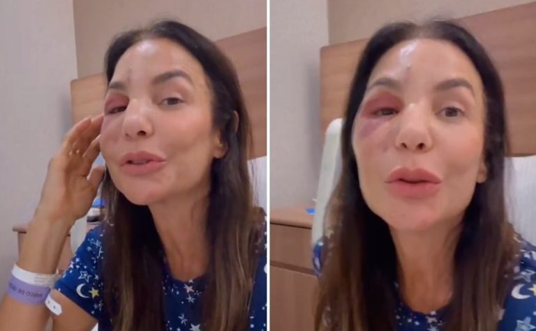 Ivete Sangalo ressurge após cirurgia no rosto: ‘Poderia ter sido tão pior’