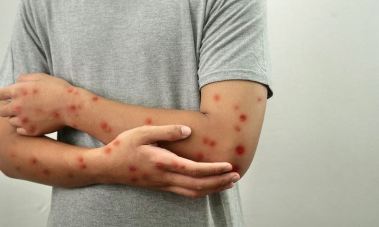 Sesa confirma terceiro caso de Mpox no ES em 2026