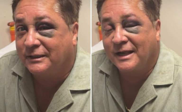 Cantor Leonardo sofre acidente e aparece com os olhos roxos e inchados