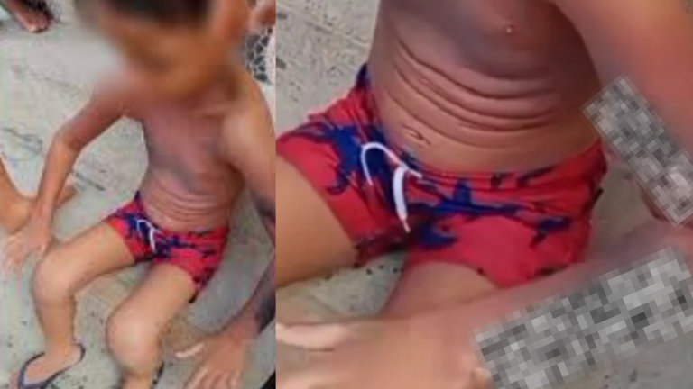 Criança sofre queimaduras de 3º grau após explosão de celular no Recife