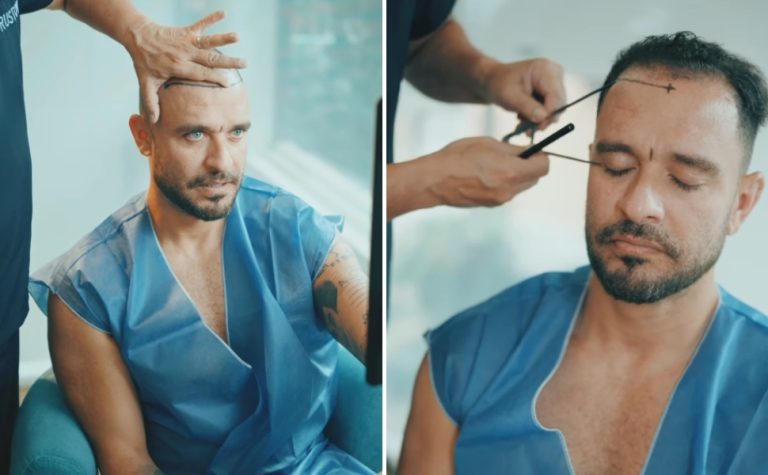 Diogo Nogueira faz novo transplante capilar