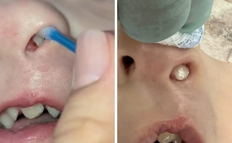 Em caso raro, dente nasce dentro do nariz de criança de 3 anos no Paraná