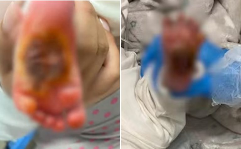 Bebê que teve pé queimado em maternidade da Serra tem cirurgia cancelada