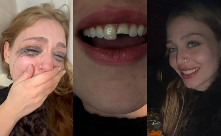 Jovem quebra dente na balada, cola na madrugada e volta para a festa