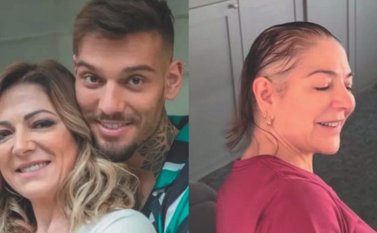 Alopecia: causas e tratamentos da doença que afeta famosos