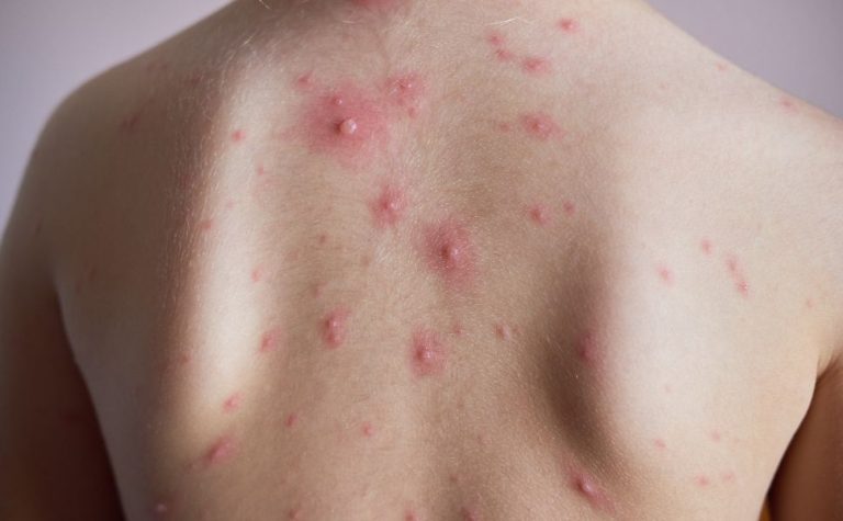 Casos de catapora crescem no ES e cidades emitem alerta