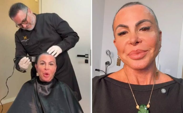 Gretchen raspa a cabeça ao vivo antes de transplante capilar feito no ES